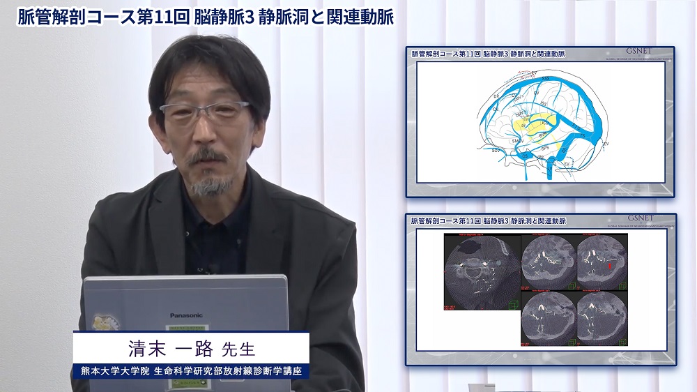 グローバル脳血管内治療講座